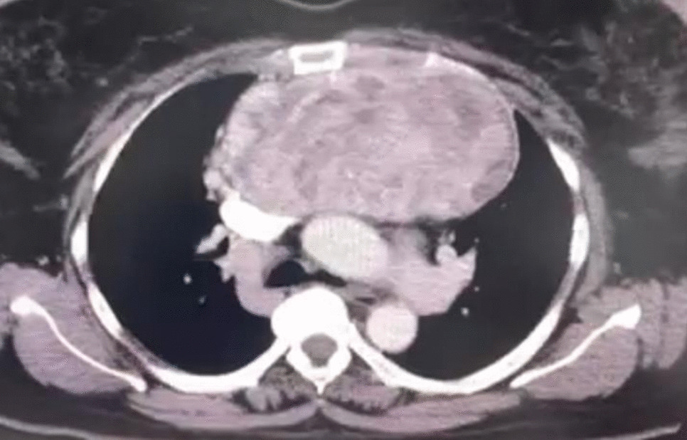 Rare Case of A Largest Intrathoracic Thyrothymic Thyroid Rest (TTR) with SVC Compression