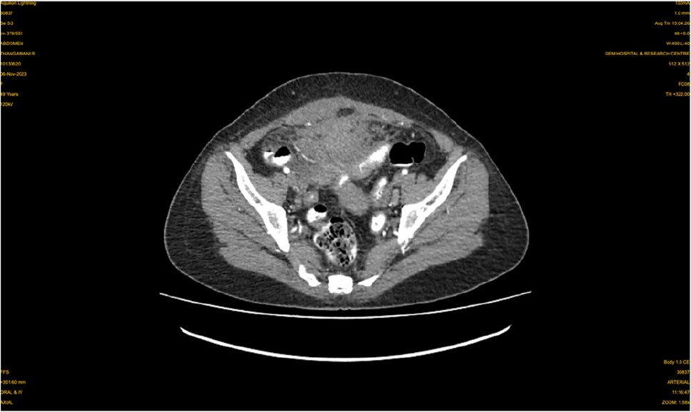 Unveiling Complexity: A Surgeon’s Insight into the Diagnostic Challenges of a Rare Intraabdominal Mass—Pelvic Actinomycosis