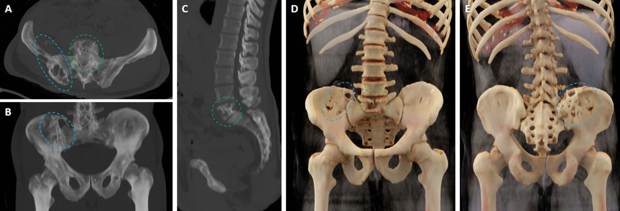 Tumour-like Destruction of the Iliac Wing and Vertebrae Due to Eccinococcus Granulosis Infection