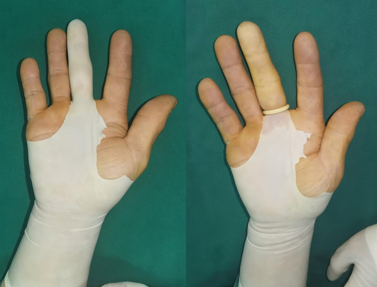 A Comparative Study of Modified Glove Roll Tourniquet Versus Conventional Rubber Band Tourniquet in Digital Surgery