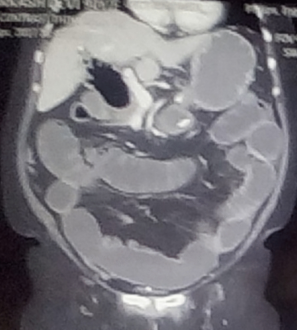 A Rare Case of Acute Small Bowel Obstruction as a Sequelae to Primary Choledocholiathiasis in a Post-cholecystectomy Patient: A Case Report