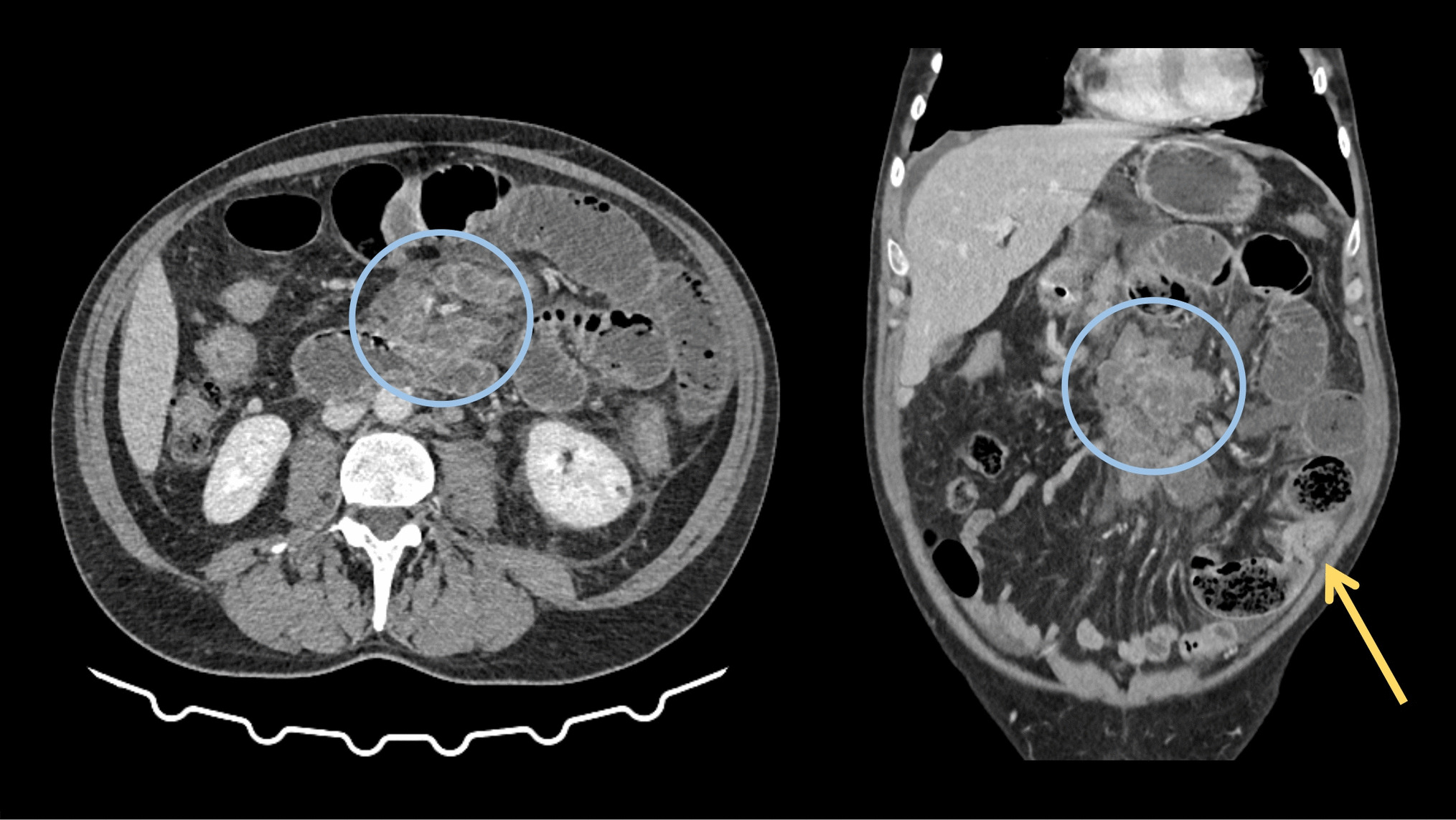 Small Bowel Obstruction Secondary to Jejunal Metastases of Lung Adenocarcinoma: Clinical Insights and Literature Review