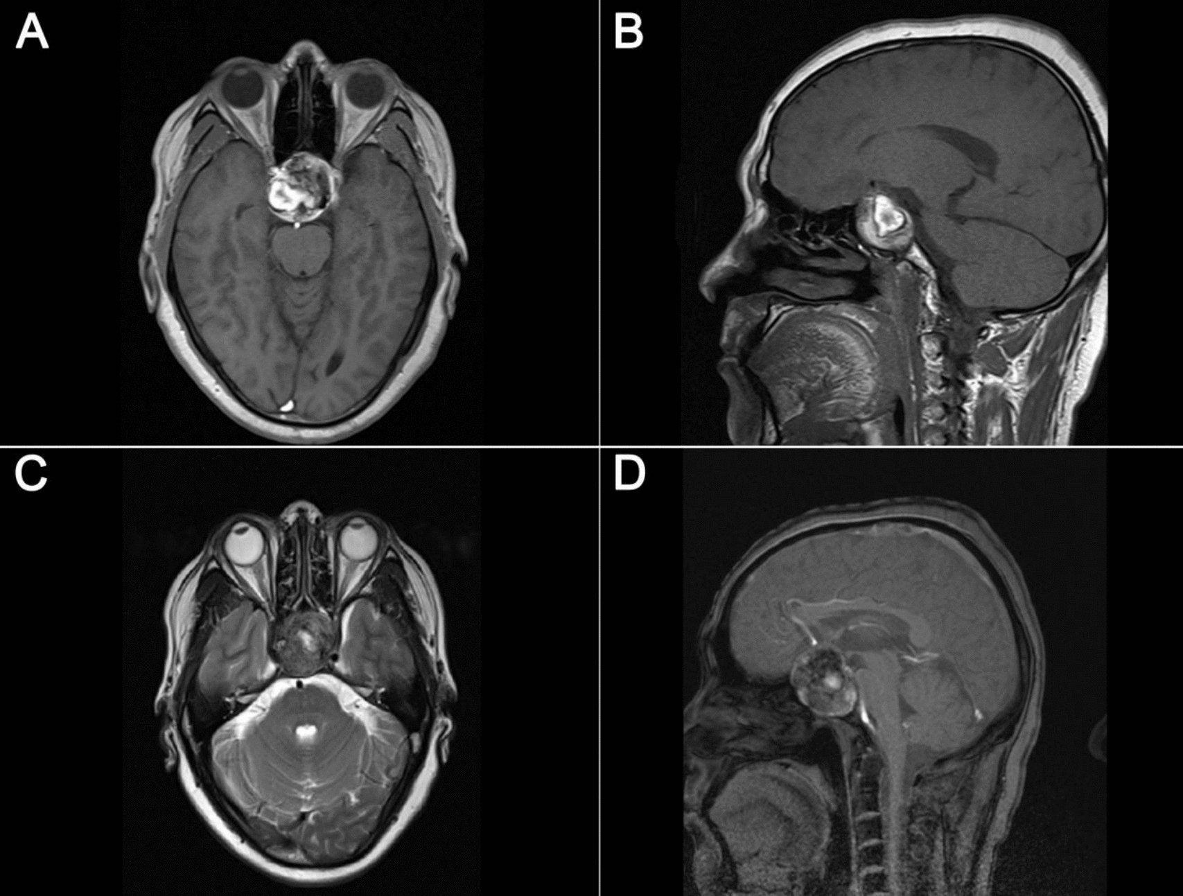 Primary pigmented papillary epithelial tumor of the sella: case report and literature review