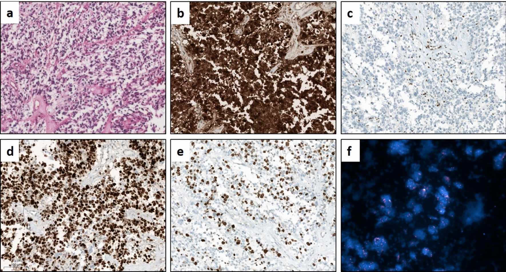 CLINICAL utility of assessing  status in recurrent astrocytomas