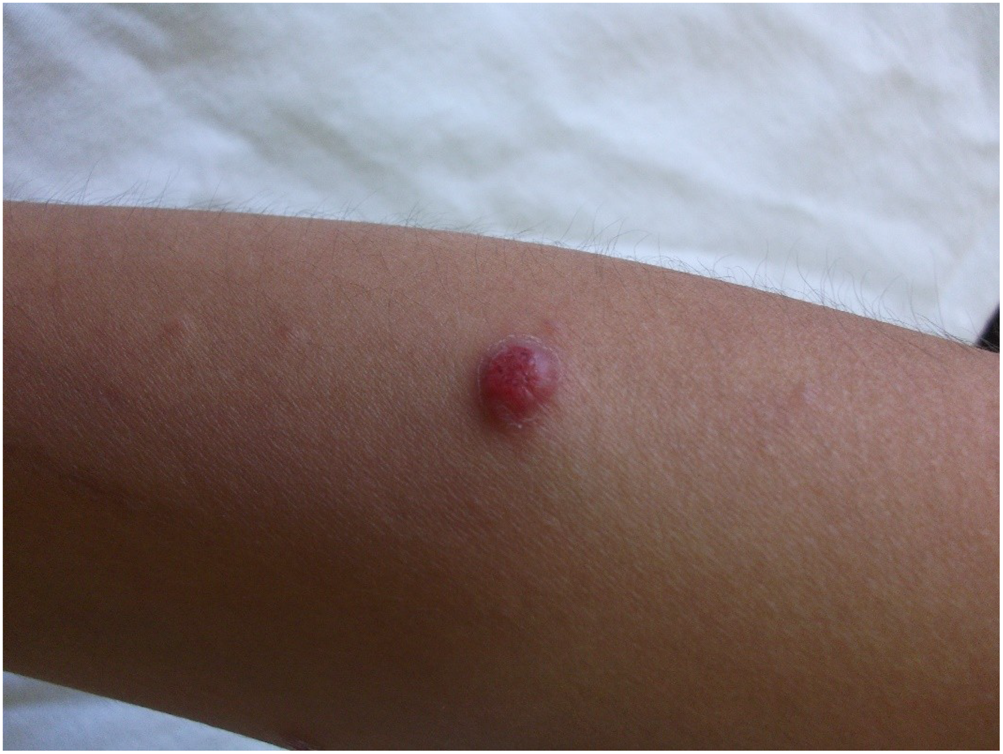 Histopathology of the Th2-Mediated Immune Response in Paracoccidioidomycosis
