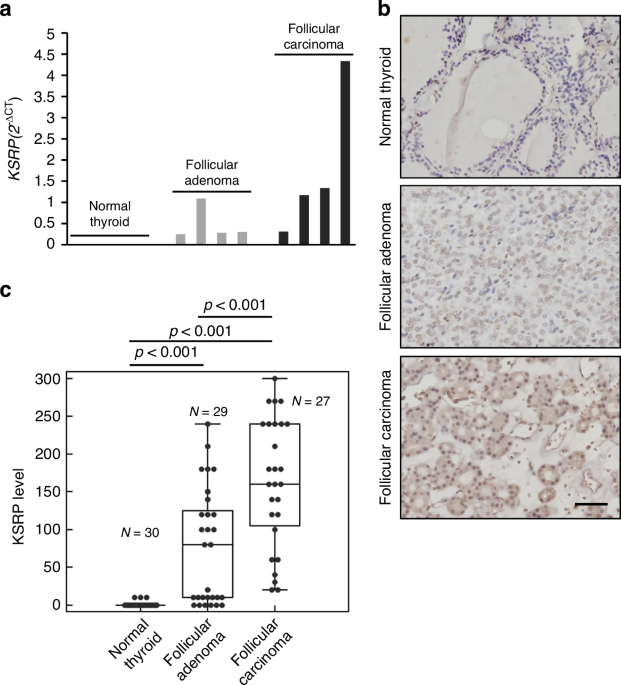 KSRP-mediated Wnt/β-catenin activation promotes follicular thyroid cancer progression and stemness