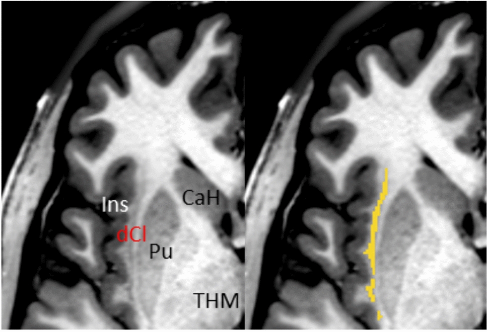 A comprehensive and reliable protocol for manual segmentation of the human claustrum using high-resolution MRI