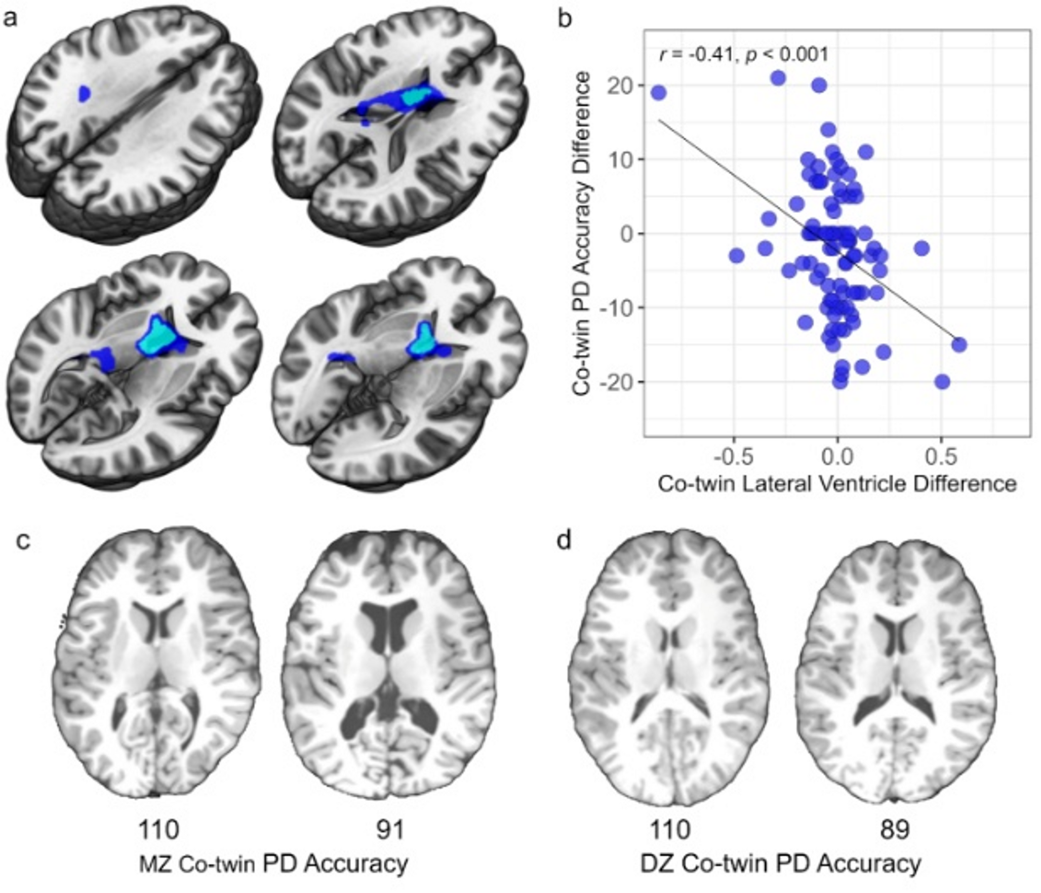 Twin differences in lateral ventricle size accompany twin differences in phonological decoding
