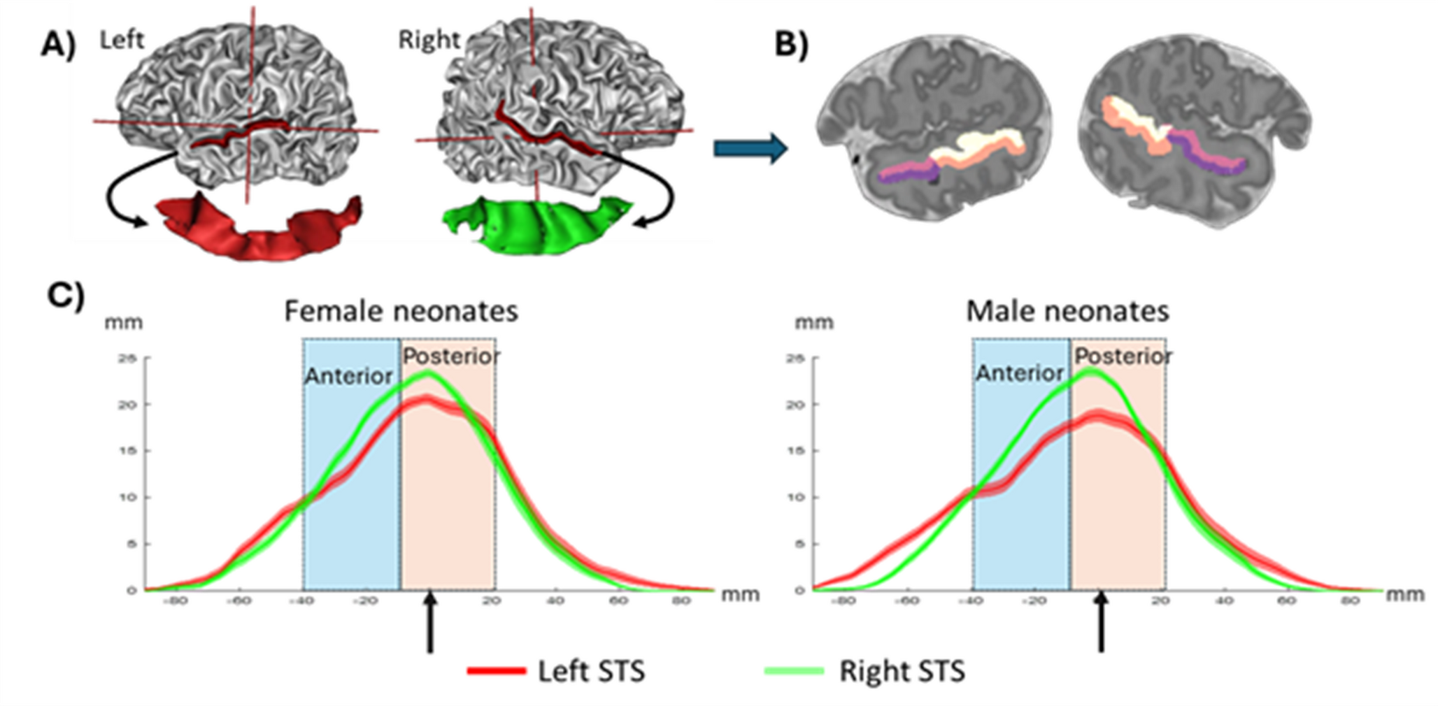 Functional connectivity of the superior temporal sulcus at term-equivalent age: effects of gestational age and sex