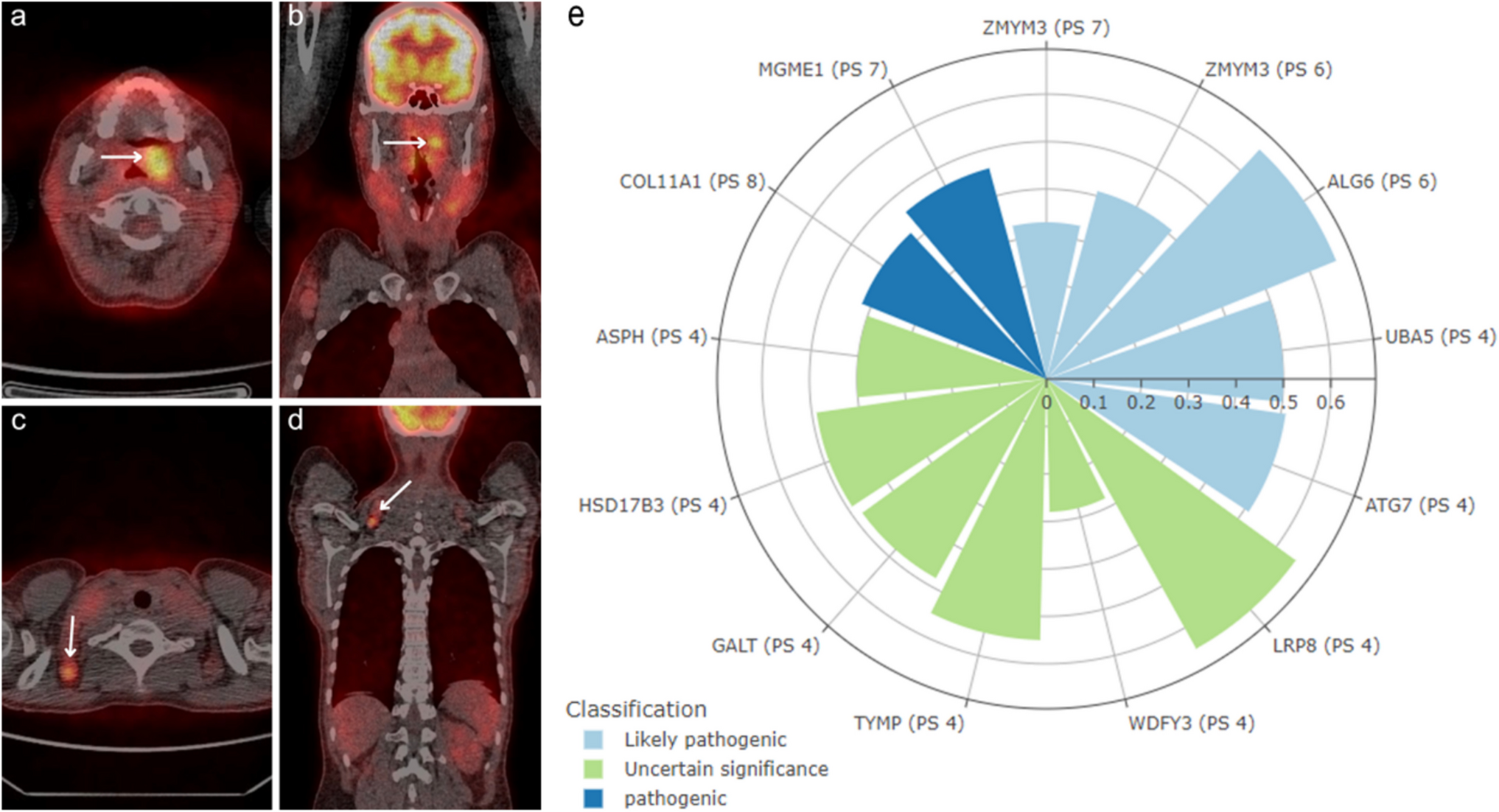 Genetic background of Richter transformation of atypical chronic lymphocytic leukemia to diffuse large B-cell lymphoma - a case study
