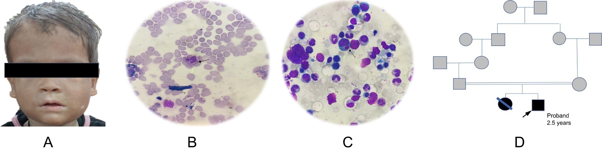 Masquerading as lymphoma: the accelerated phase of Chediak–Higashi syndrome and its novel mutation