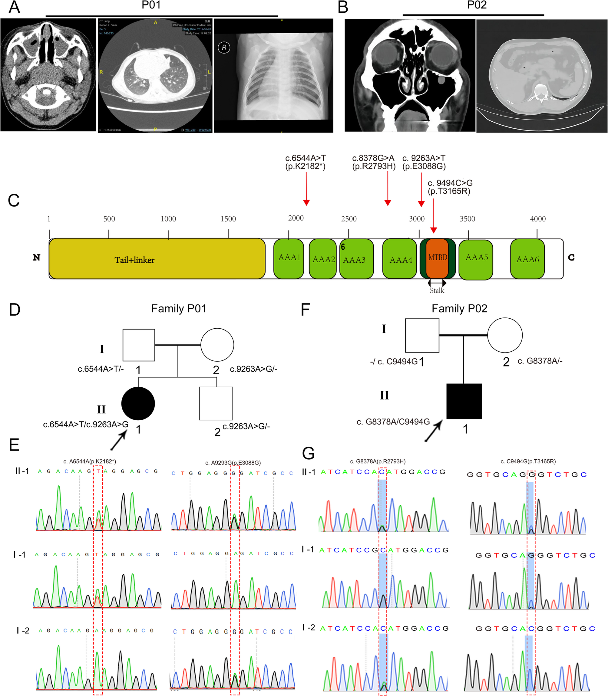 DNAH10 mutation cause primary ciliary dyskinesia with defects of IDAf complex assembly and lung fibrosis manifestation