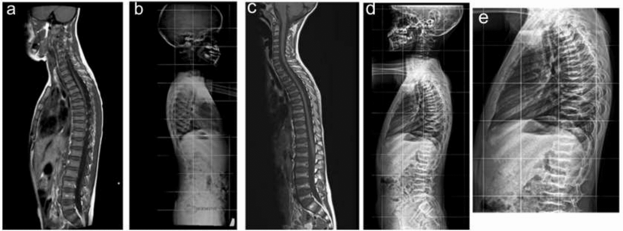 Clinical, Biochemical and Radiological Features of  Gene Variants in Children