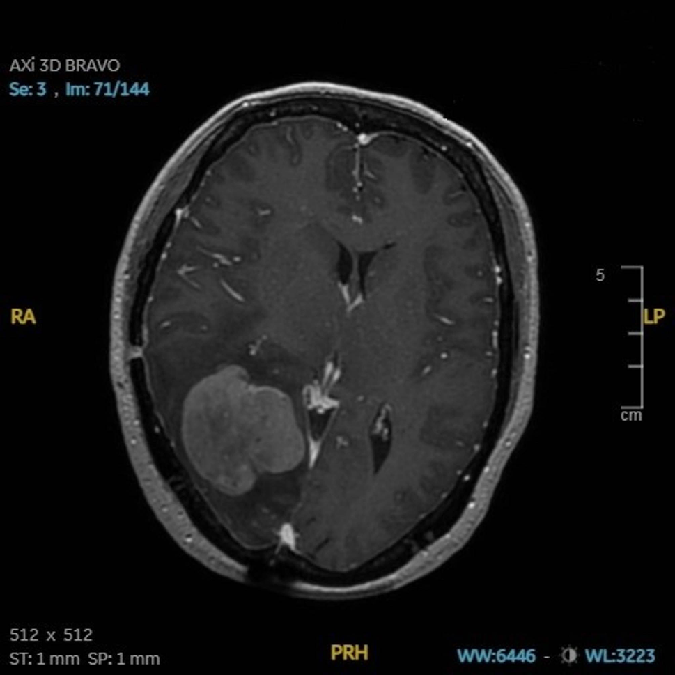 A case report: capillary leak syndrome in a patient receiving high-dose methotrexate, Tislelizumab and zanubrutinib for CNS lymphoma