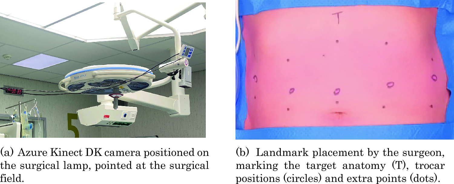 Towards personalized trocar placement: assessment of patient-specific abdominal wall distension due to pneumoperitoneum