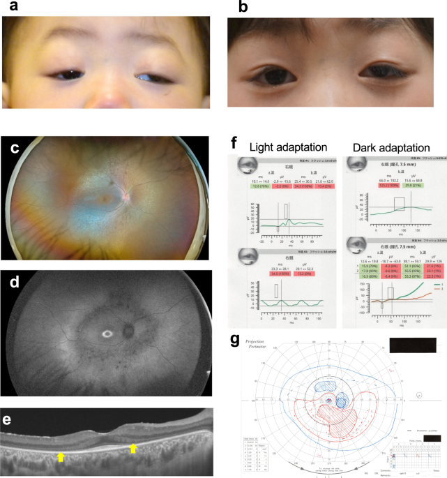 Novel biallelic CDK9 variants are associated with retinal dystrophy without CHARGE-like malformation syndrome