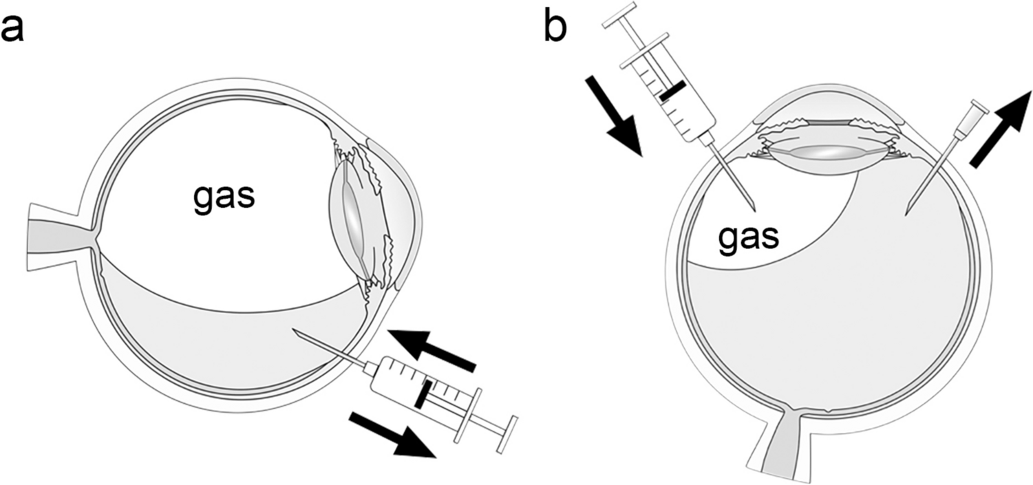 Rescue pneumatic retinopexy for recurrent retinal detachments due to superior retinal breaks following initial vitrectomy