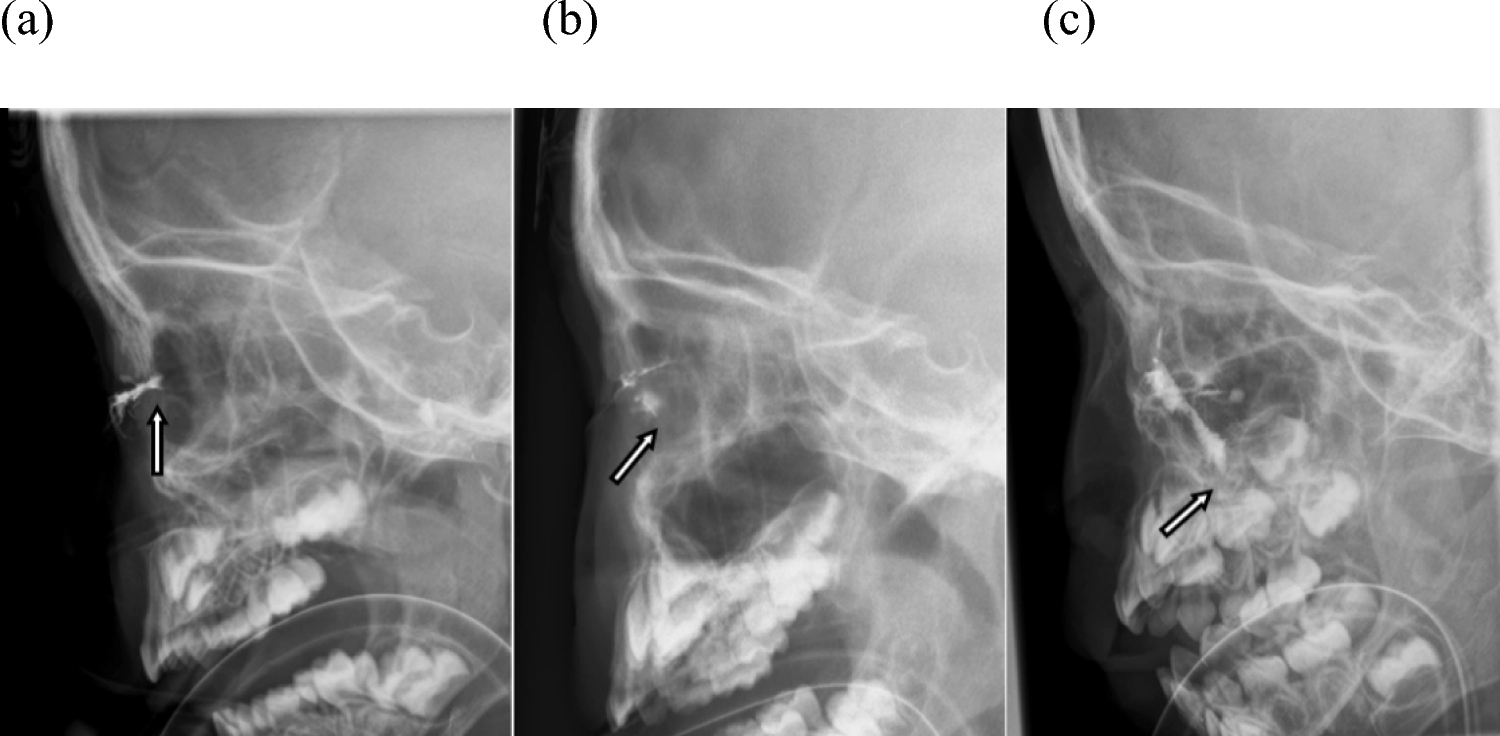 Endoluminal lacrimal duct recanalization for pediatric secondary acquired lacrimal duct obstruction following epidemic keratoconjunctivitis