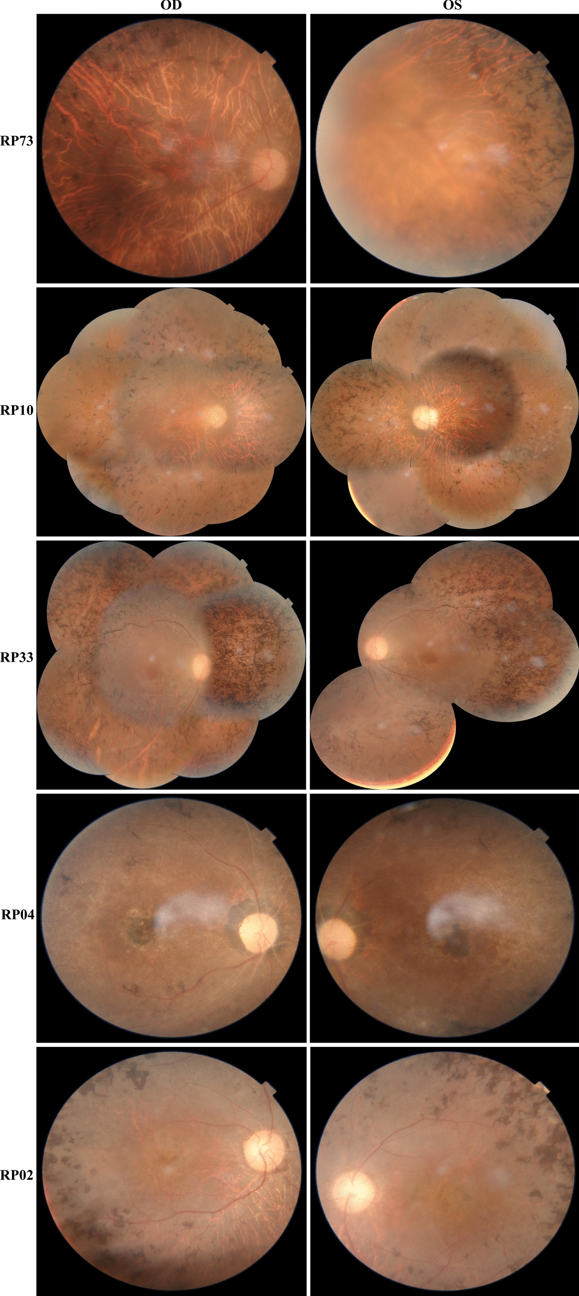 Genetic and bioinformatic analysis of  and  variants in north Indian retinitis pigmentosa patients