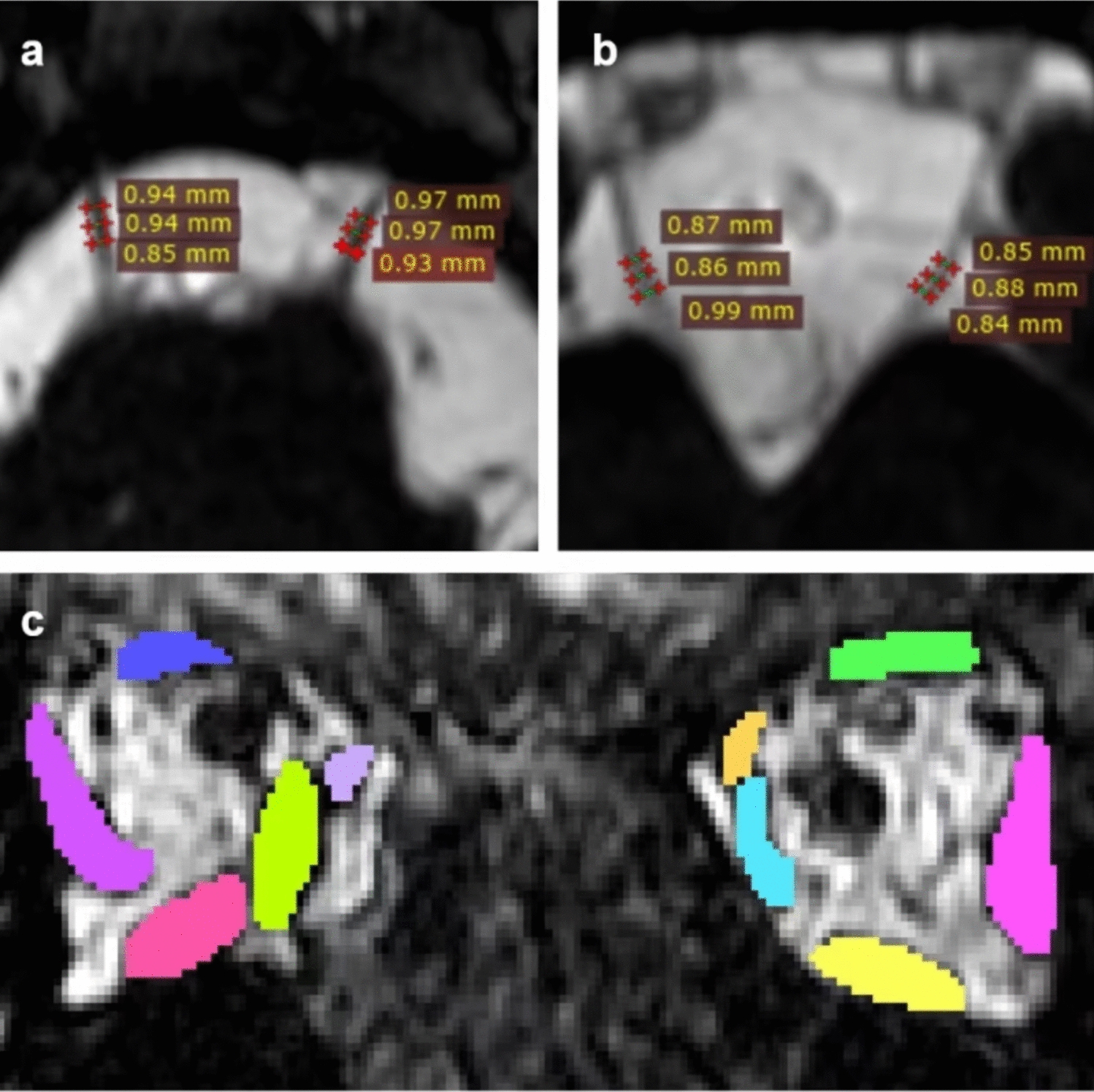 Clinical and MRI differences in congenital fibrosis of extraocular muscles patients with  and  variants