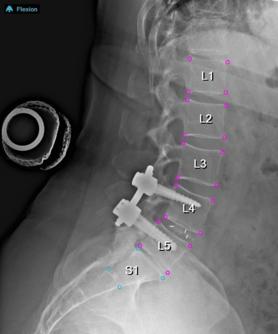 Investigating the Effects of Image Scaling Techniques in Radiographic Measurements of Spinal Alignment and Motion: A Comparative Analysis