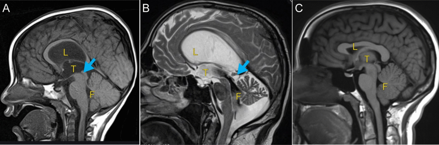 Exploring Ciliary Mechanisms in the Causation of Hydrocephalus in Humans—Similarities and Differences from Animal Models