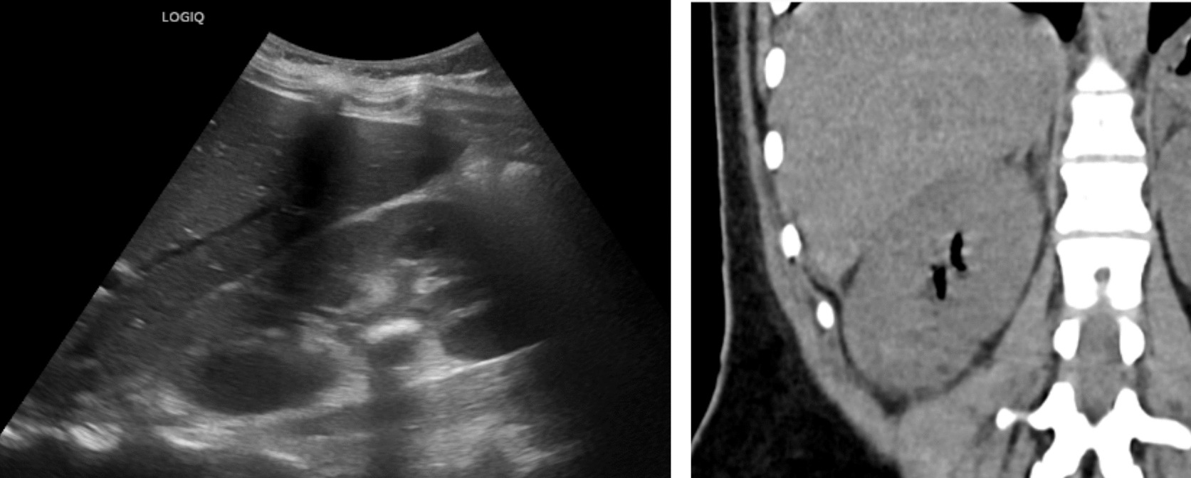 Emphysematous pyelonephritis and infection-related calculi