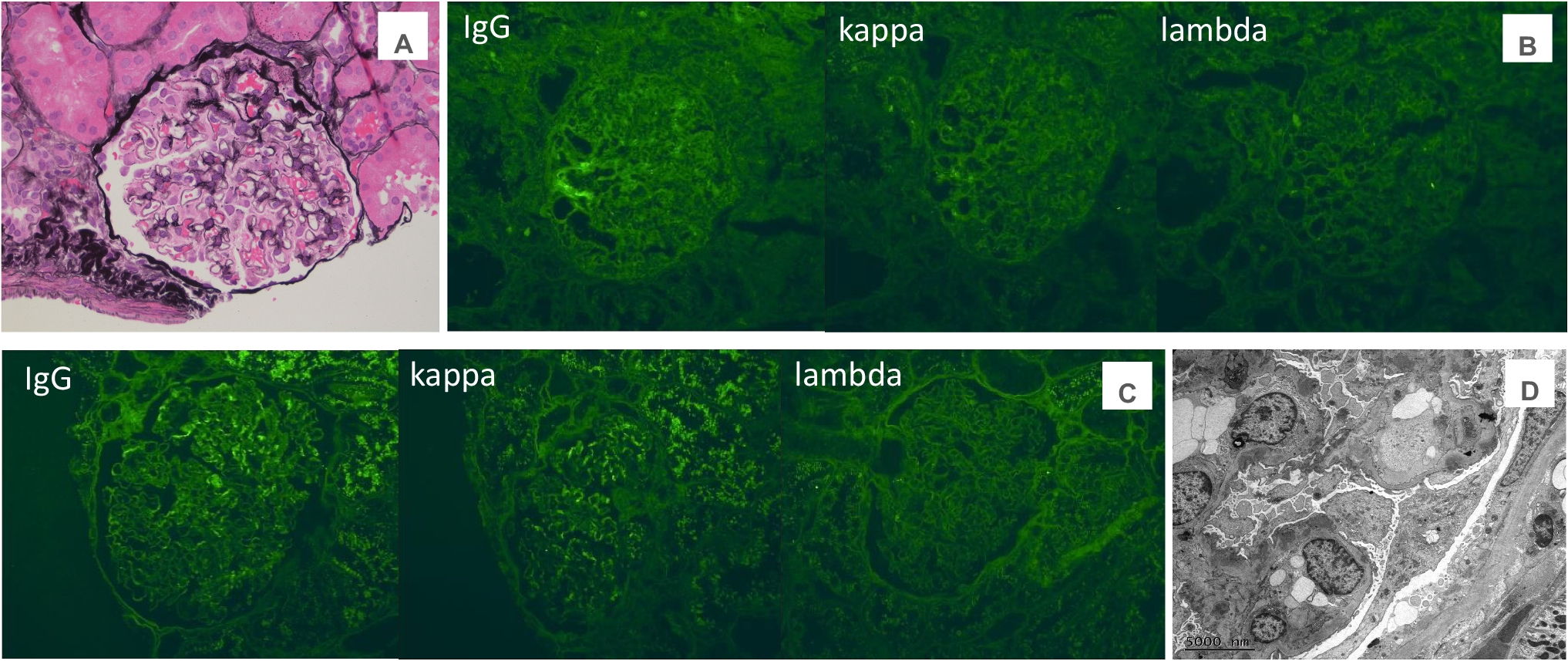 Membranous-like glomerulopathy with masked IgG-k deposits in a pediatric patient with juvenile idiopathic arthritis