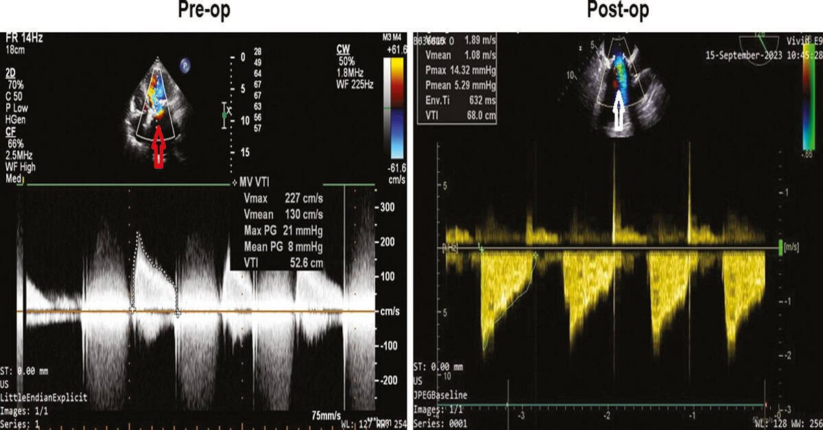Total Endoscopic Transcatheter Mitral Valve-in-Valve Replacement with Concomitant Left Atrial Appendage Occlusion and Tricuspid Valve Repair