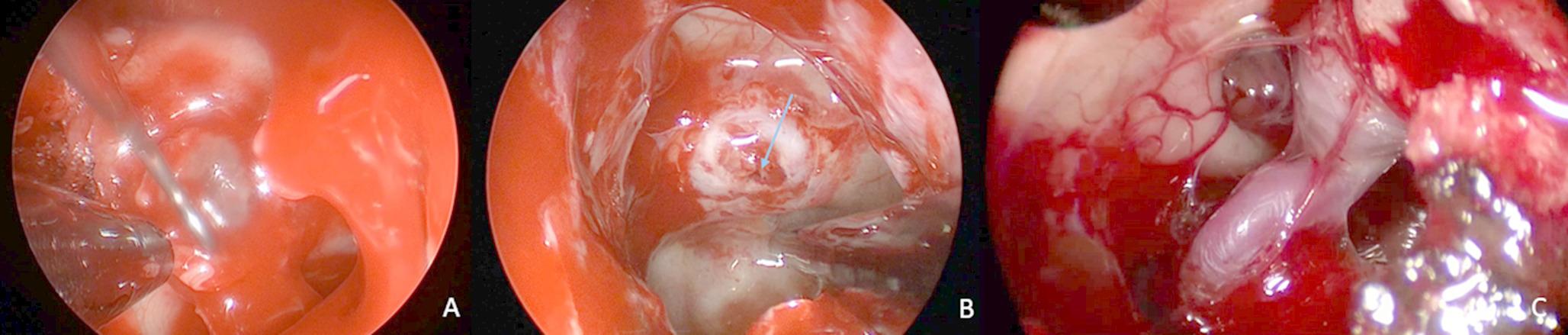 Dural repair after intraoperative CSF leakage in endoscopic endonasal skull base surgery without pedicled nasoseptal flap: is it a safe surgical technique?