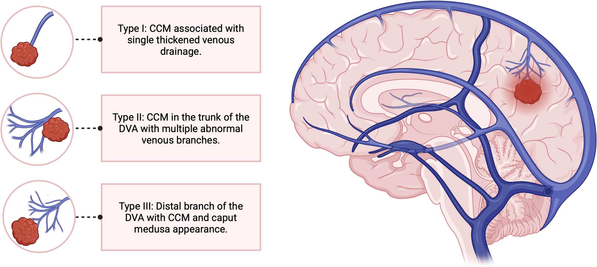 Single vs. multiple lesions in sporadic cerebral cavernous malformations: the role of developmental venous anomalies