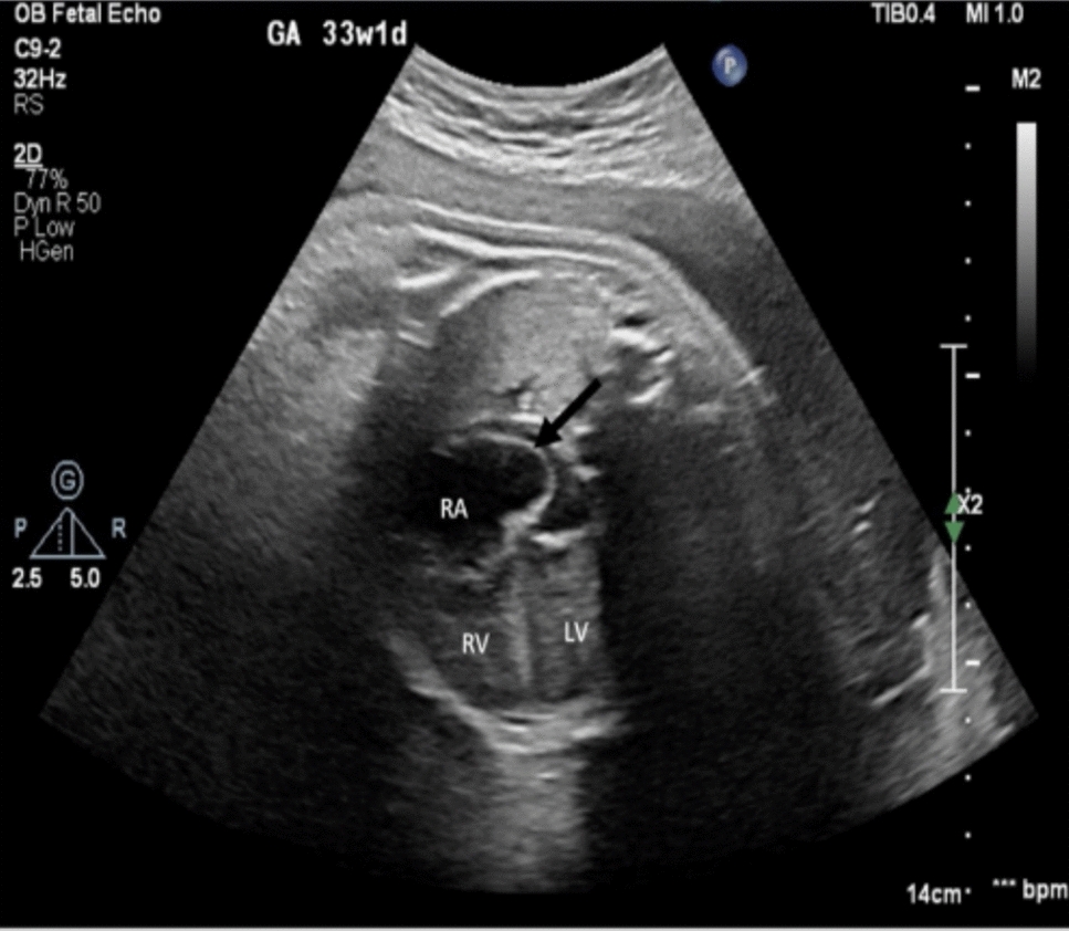 In Utero Diagnosis of Premature Closure of the Foramen Ovale: A Retrospective Case Series Analyzing Neonatal Interventions and Maternal Factors