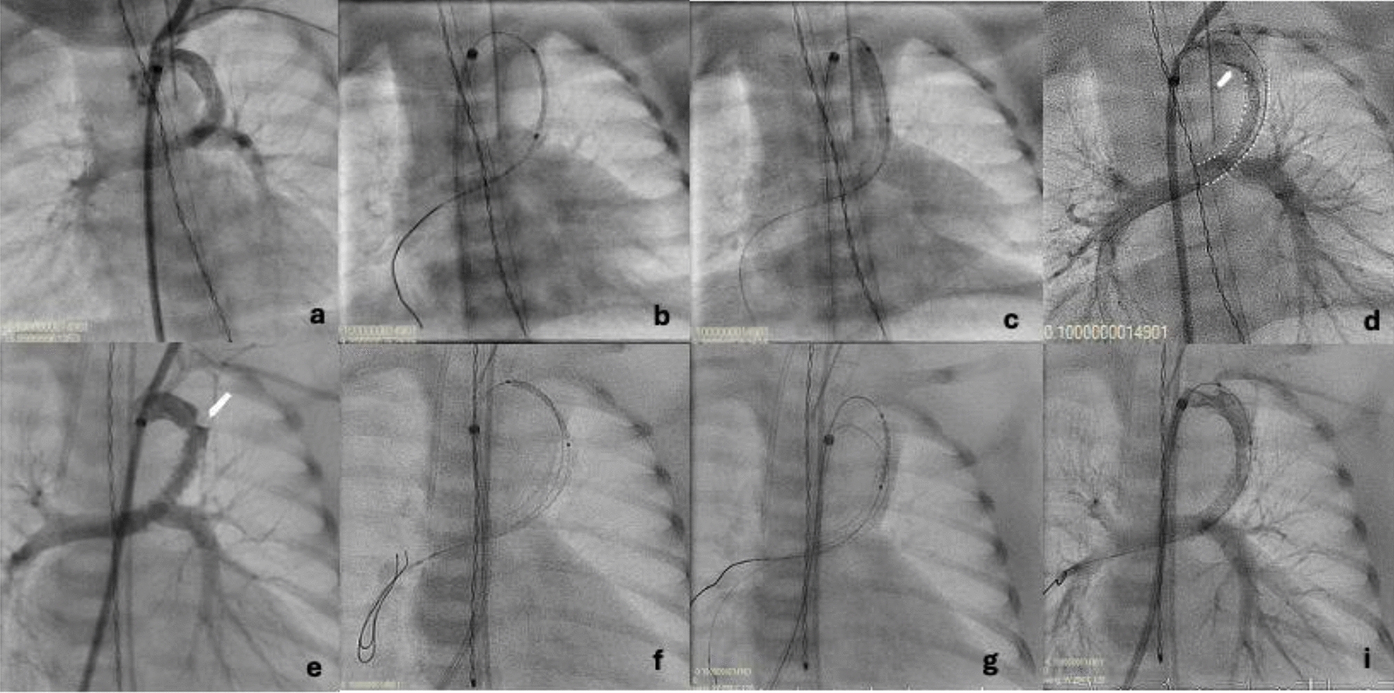 Re−interventions Following Patent Ductus Arteriosus Stenting During the Inter-stage Period