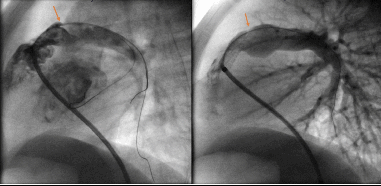 Outcomes After Stenting of Right Ventricular Outflow Tract for Tetralogy of Fallot and Its Variants
