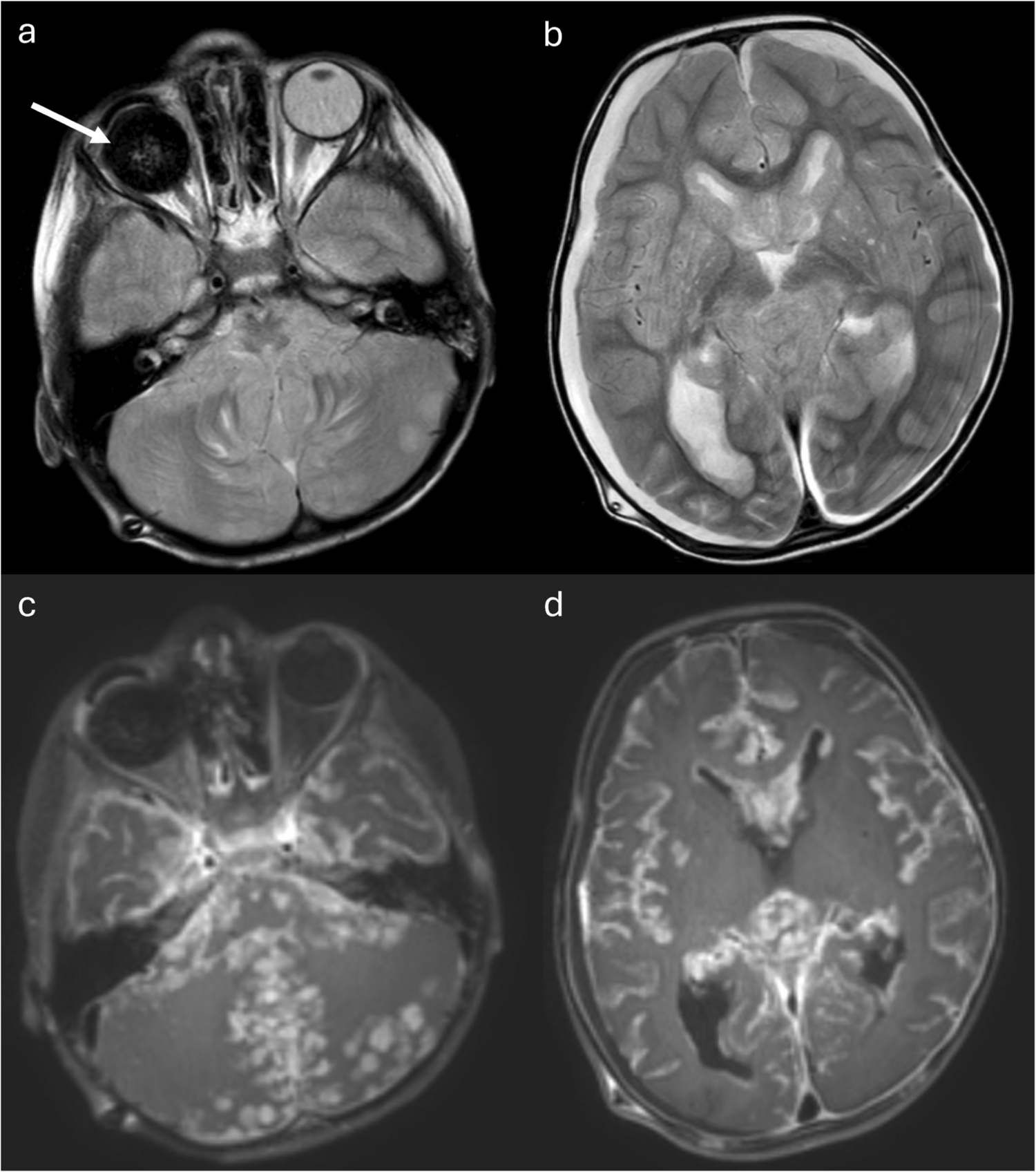 Cerebrospinal fluid metastasis in retinoblastoma - a must know for pediatric radiologists: reply to Ching et al