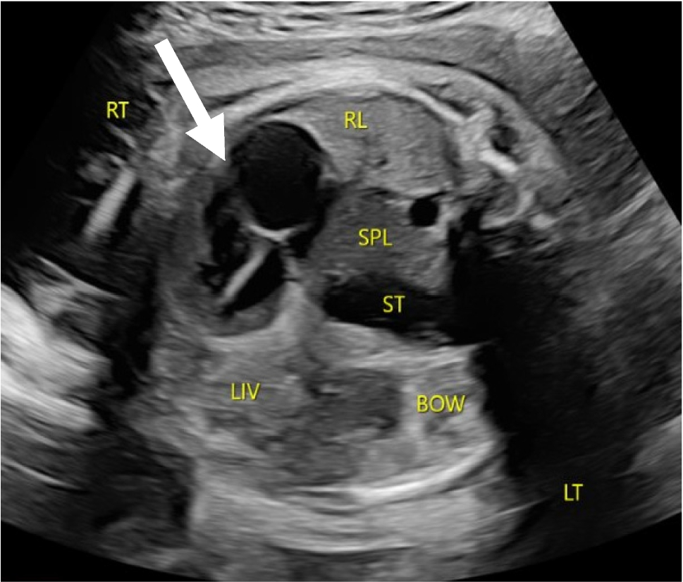 Alphabet soup: a systematic approach to understanding congenital chest lesions
