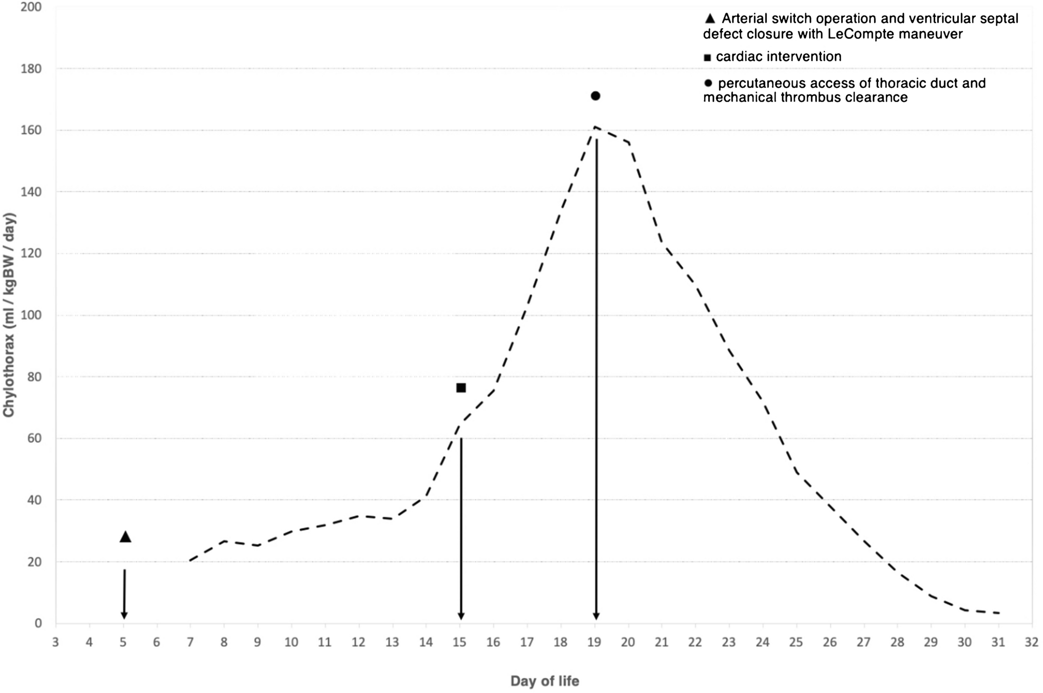Direct percutaneous access of the thoracic duct in a neonate as curative treatment of a high-output life-threatening chylothorax due to thrombotic occlusion of the thoracic duct–venous junction