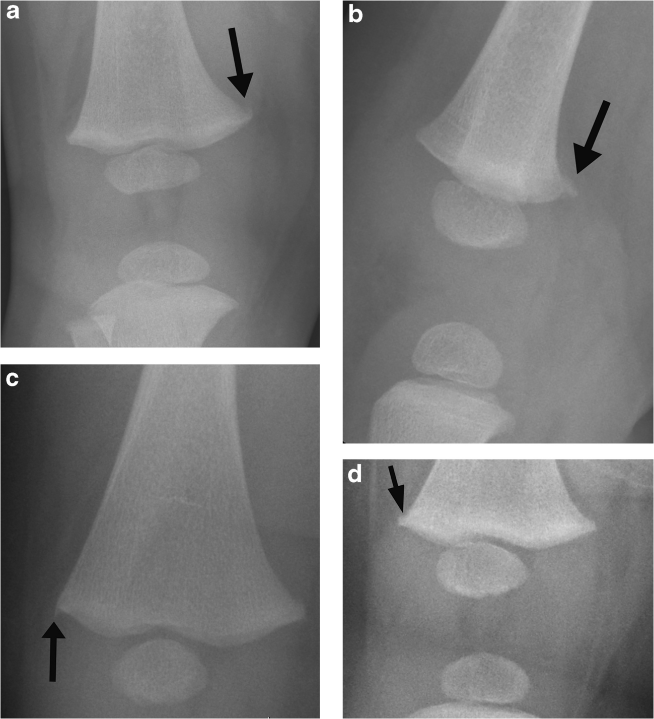 Can metaphyseal variations in the distal femurs and proximal tibias be distinguished from classic metaphyseal lesions?
