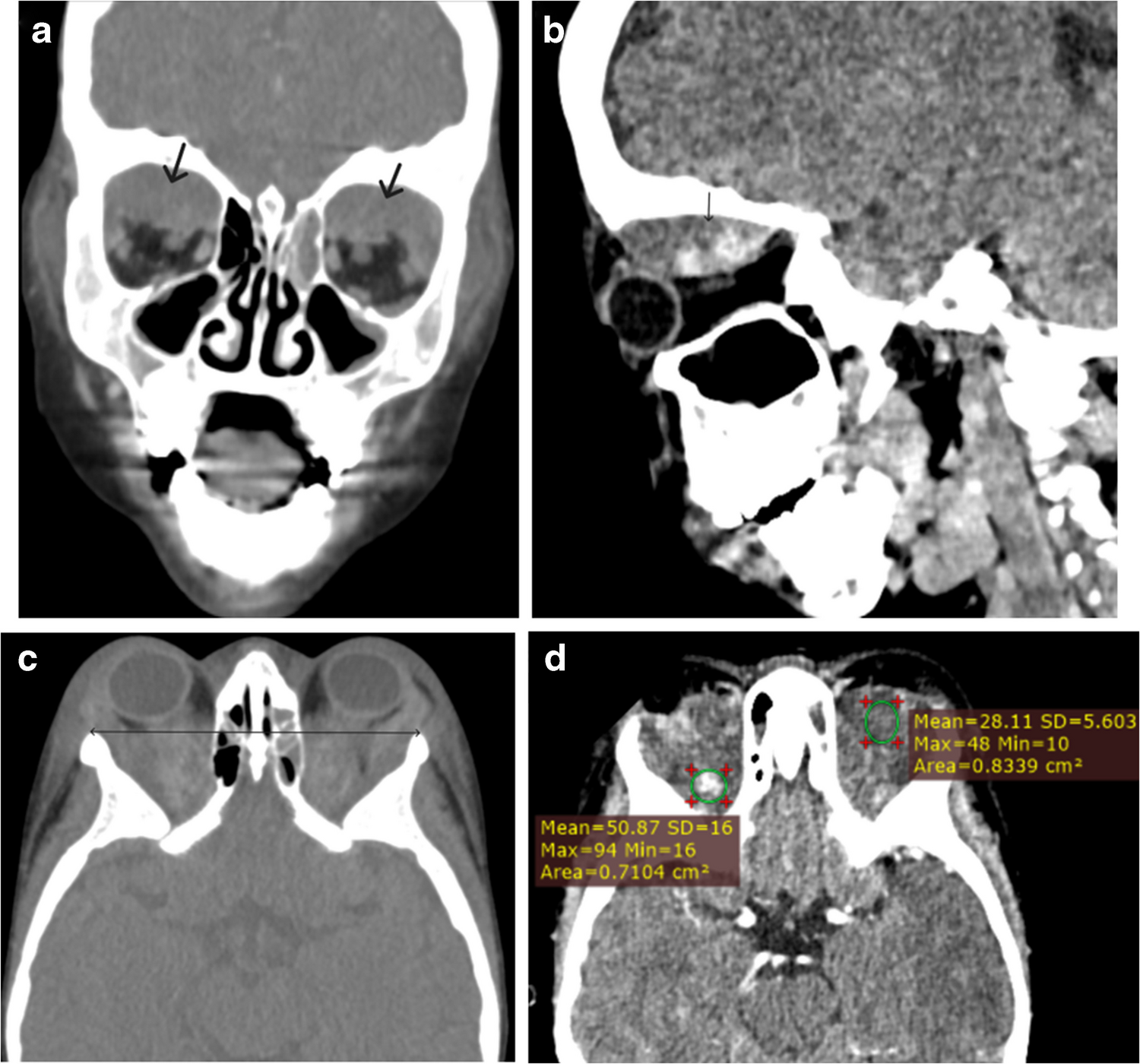 When sickle cell disease strikes the orbits: a rare pediatric case of bilateral subperiosteal hematomas