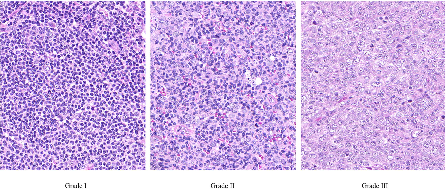 Grade I, II and III Follicular Lymphomas Express Ig V Genes with Different Patterns of Somatic Mutation