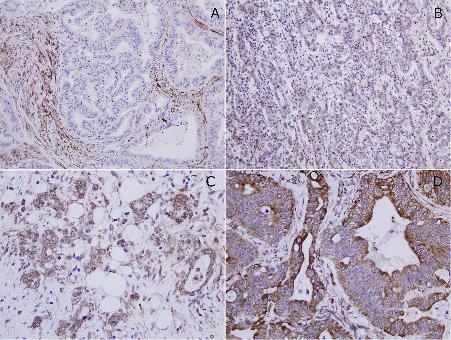 Prognostic Role of Aryl Hydrocarbon Receptor Interacting Protein (AIP) Immunohistochemical Expression in Patients with Resected Gastric Carcinomas