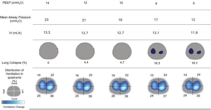 Identifying optimal positive end-expiratory pressure with electrical impedance tomography guidance in severe bronchopulmonary dysplasia