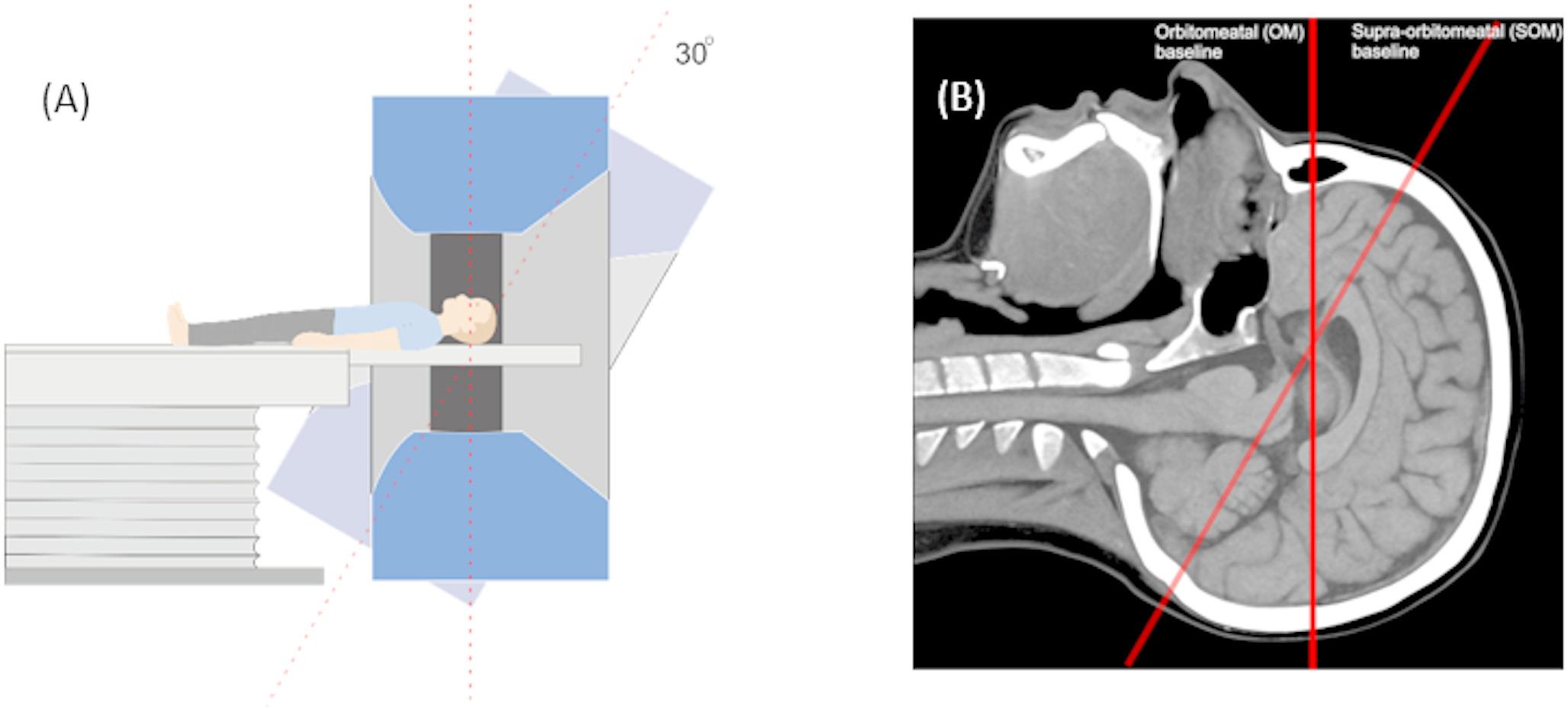 Correction of gantry tilt measurement using phantom tilt on axial CT imaging