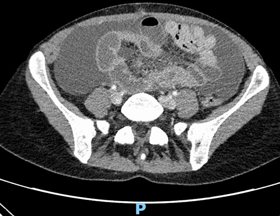 Chylous ascites following bilateral nephrectomy