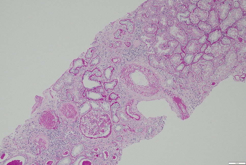 Beyond the first pregnancy: learning from the history of a kidney transplant recipient who experienced five pregnancies