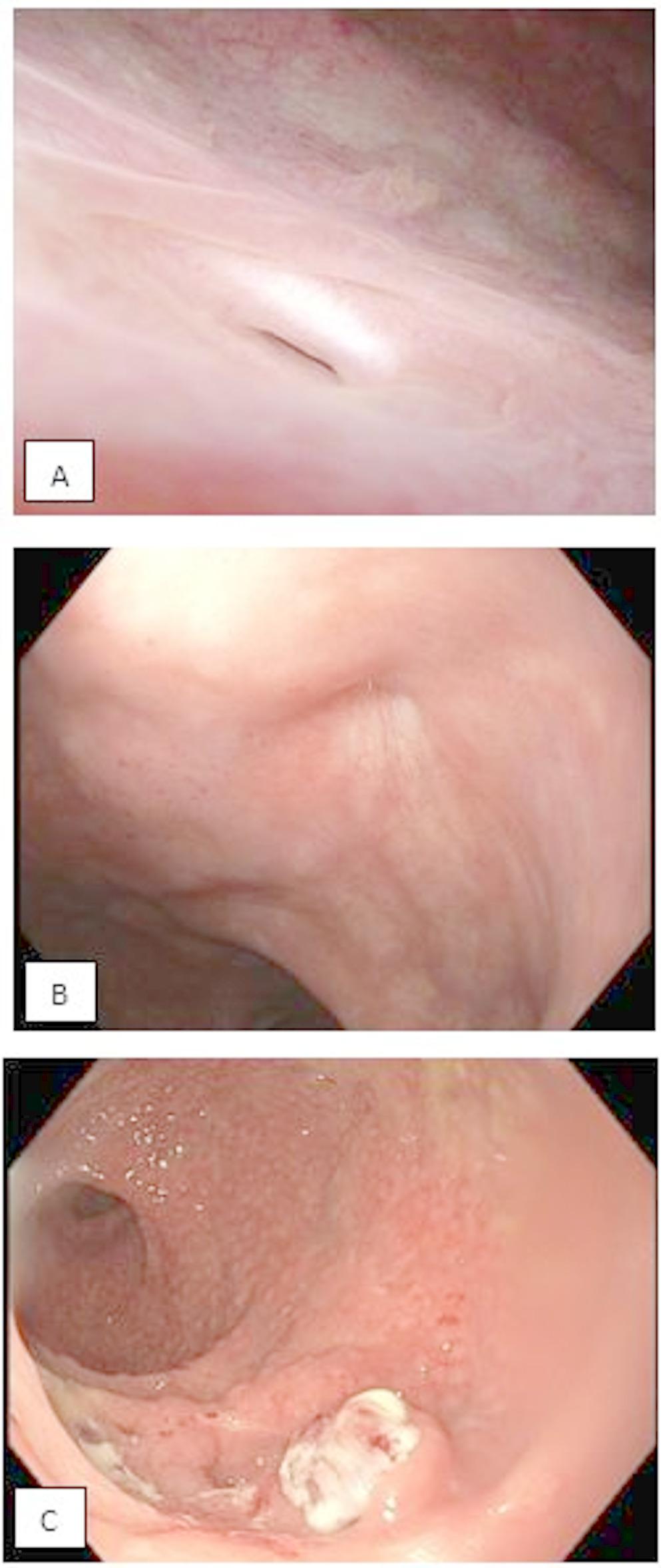 Management in robot-assisted radical prostatectomy patients with recto-urethral fistulas: the York–Mason technique