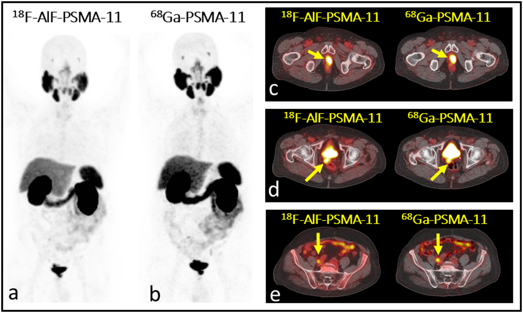 F-AlF-PSMA-HBED-CC as a novel tracer for the evaluation of prostate cancer patients with biochemical relapse: intraindividual comparison with Ga-PSMA-HBED-CC