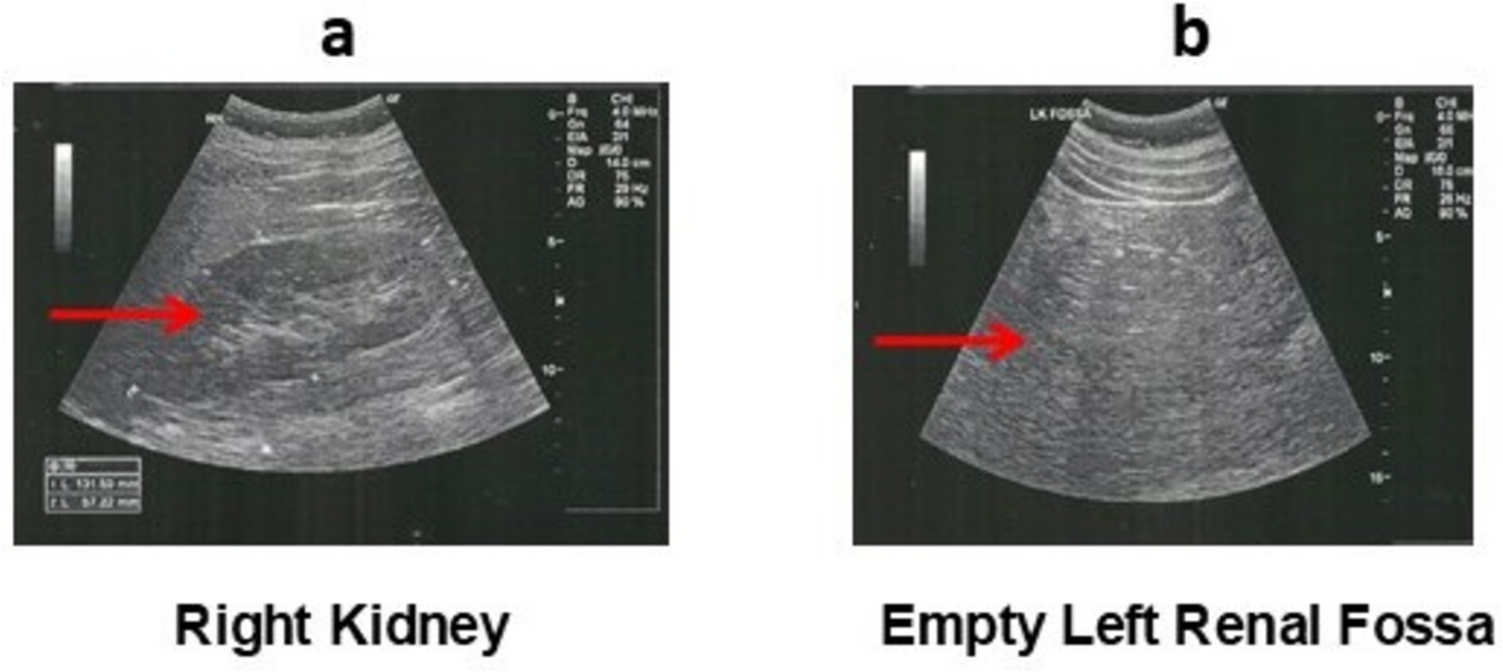 Novel Candidate Genes Identified in Men with Congenital Absence of Vas Deferens without  Gene Abnormalities