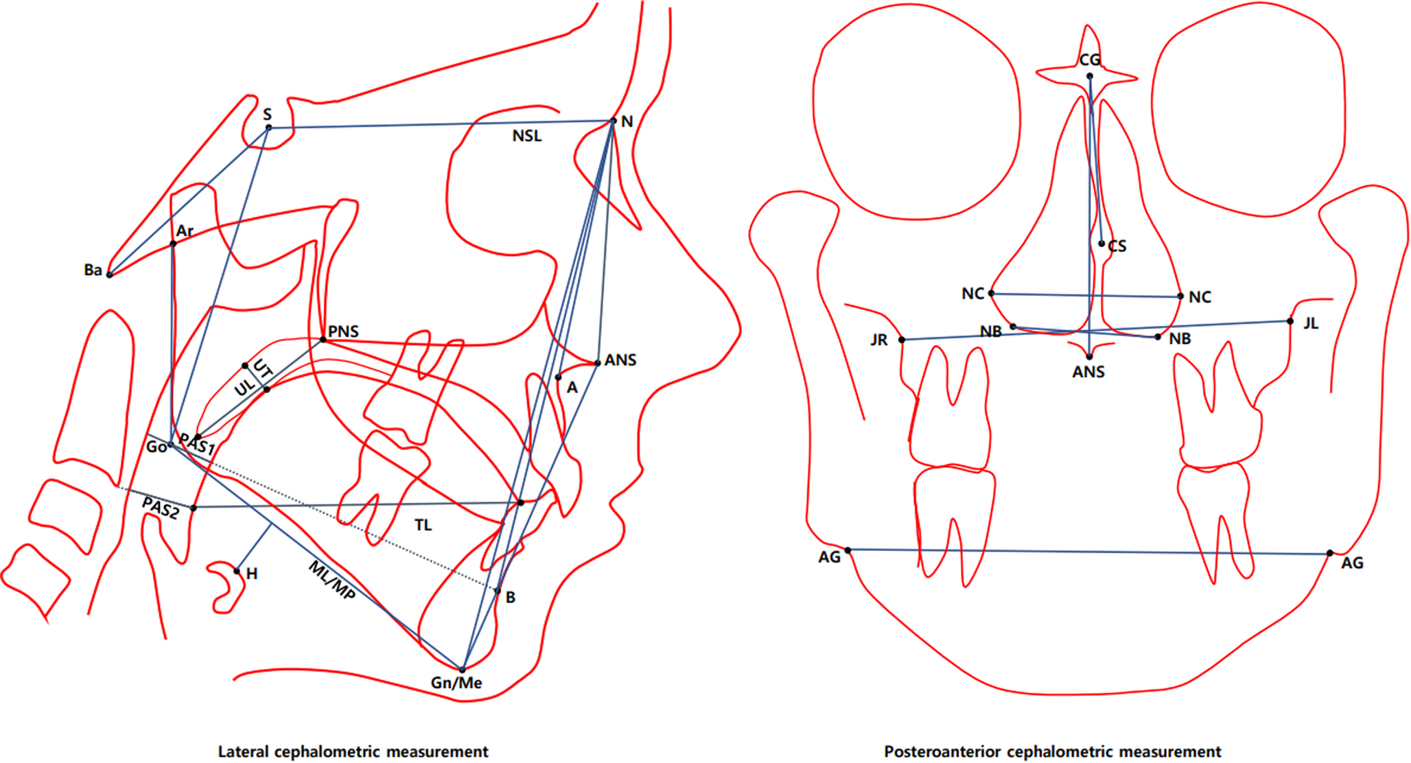 Cephalometric differences between patients with REM- and NREM-Predominant OSA: implications for selecting surgical candidates