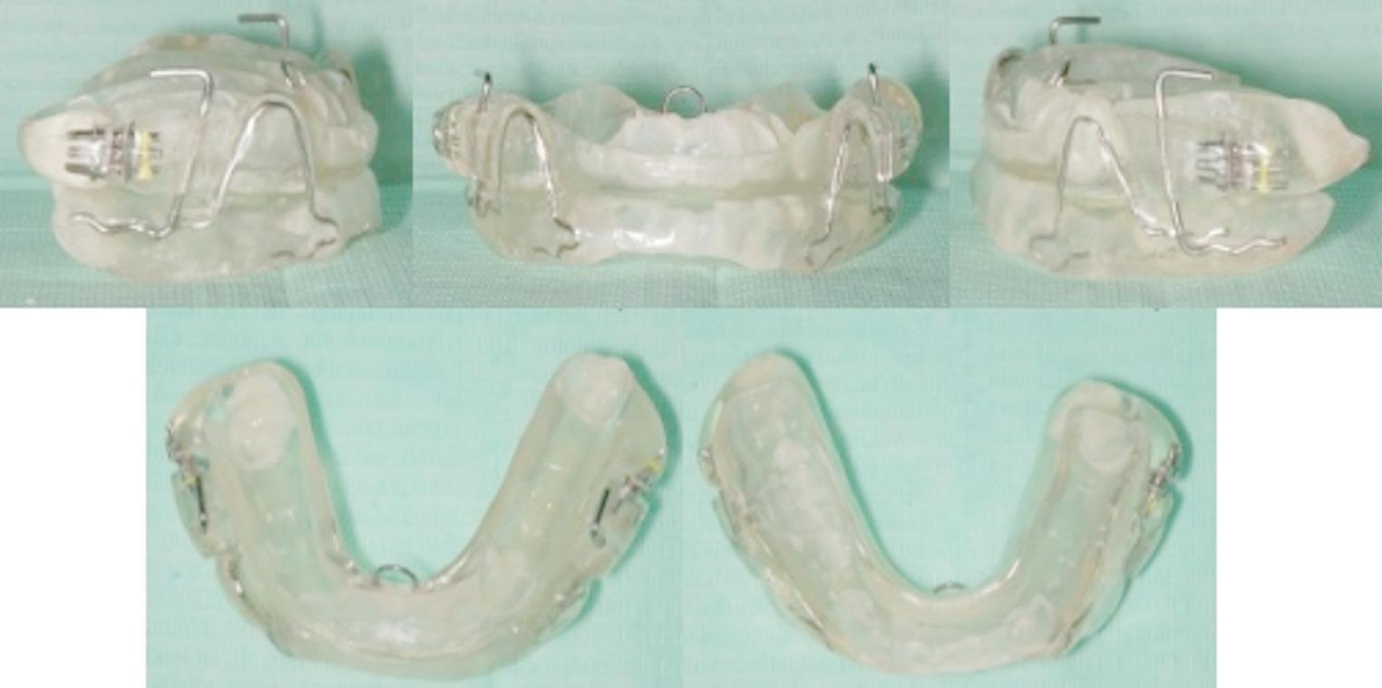 Comparative effects of MAD and CPAP on heart rate in obstructive sleep apnea